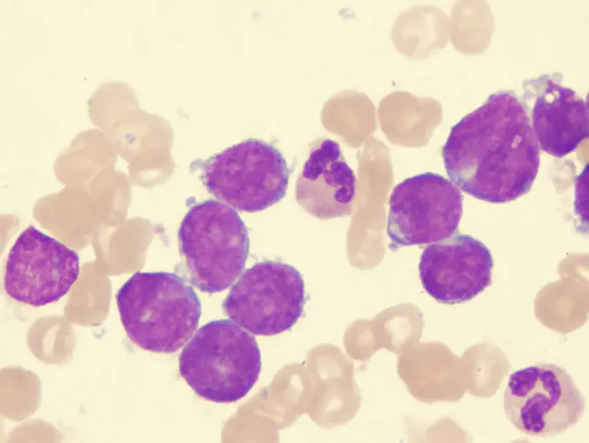 Lymphocytic choriomeningitis : 淋巴细胞性脉络丛脑膜炎