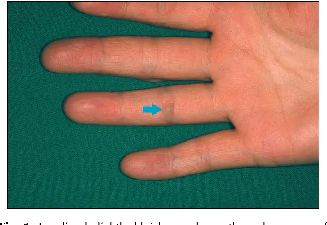 Palmar Digital Nerve Block : 帕尔玛数字神经阻滞