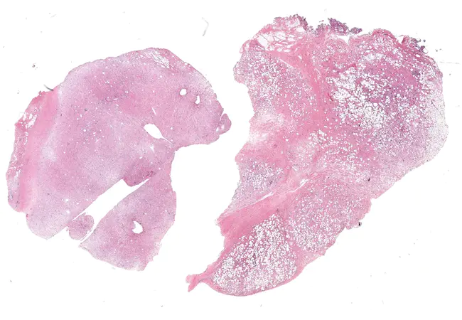 Lipomatous hypertrophy of the interatrial septum : 室间隔脂肪瘤性肥大