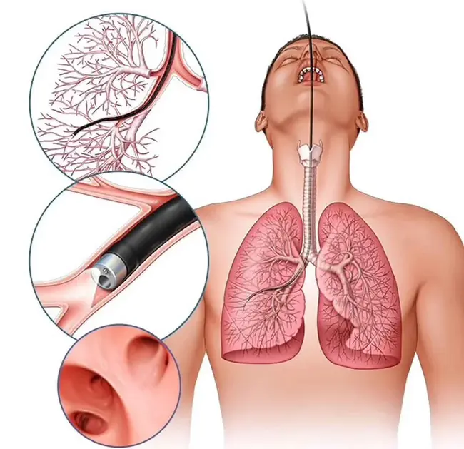 Broncho pneumopathie chronique obstructive : 支气管肺炎慢性阻塞性