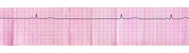 Junctional Zone : 结合区