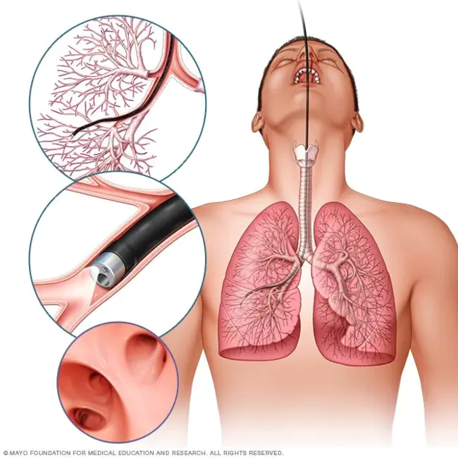 Bronchoscopic Thermal Vapour Ablation : 支气管镜热蒸汽消融术