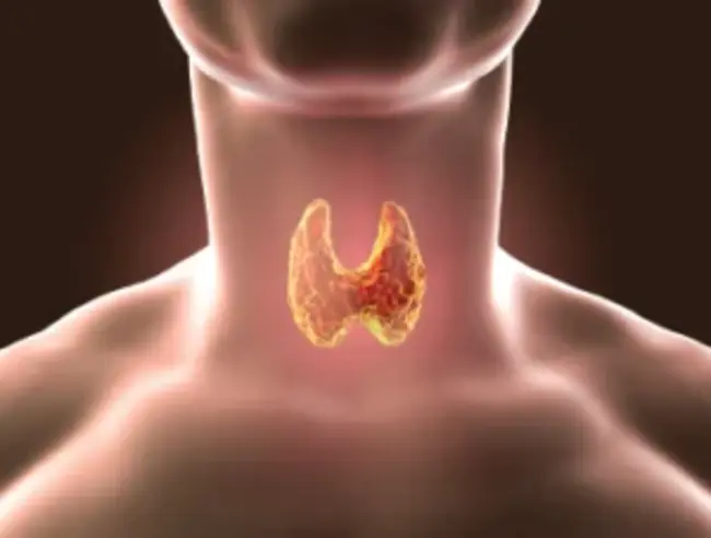 Transoral Incisionless Fundoplication : 经口无切口眼底折叠术