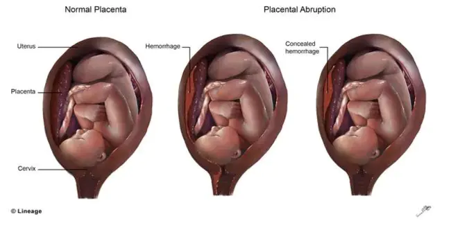 Placental Growth Factor : 胎盘生长因子