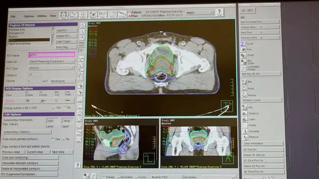 Radiotherapy Treatment Planning Tools : 放射治疗计划工具