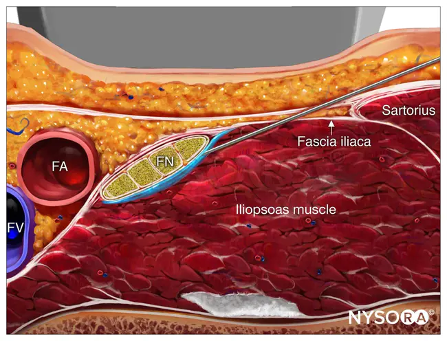 Femoral Sciatic Nerve Block : 股骨坐骨神经阻滞