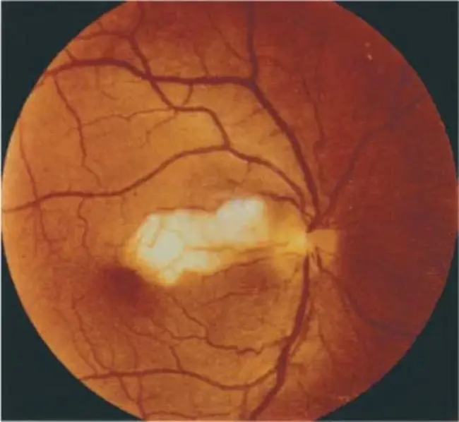 Arteritic anterior ischemic optic neuropathy : 动脉性前缺血性视神经病变