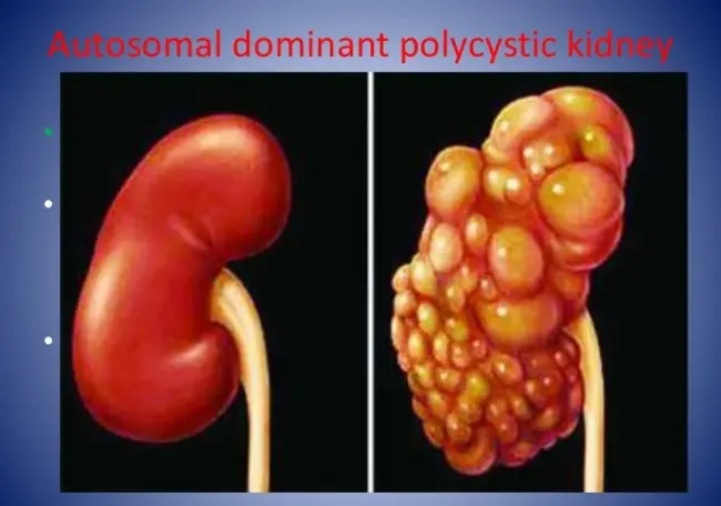 autosomal dominant hyPOcalcemic hypERcalciuria : 常染色体显性低钙高钙尿症